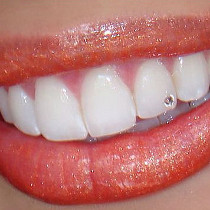 Dentální šperk